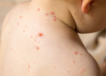 Autoridades de Salud aclaran que no hay brote de sarampión en Reynosa