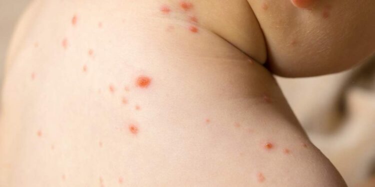 Autoridades de Salud aclaran que no hay brote de sarampión en Reynosa