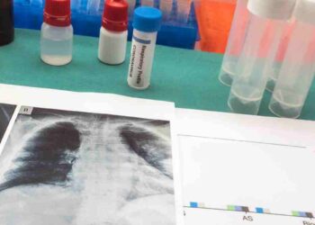 Reynosa registra 139 casos y ocho fallecimientos por tuberculosis durante el año