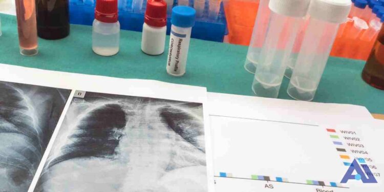 Reynosa registra 139 casos y ocho fallecimientos por tuberculosis durante el año