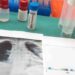 Reynosa registra 139 casos y ocho fallecimientos por tuberculosis durante el año